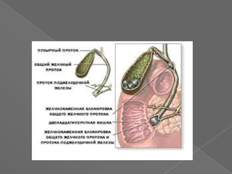 Острый холецистит презентация