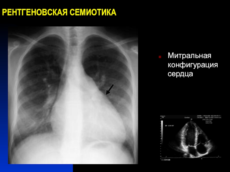 Рентгенологическая картина при митральном стенозе