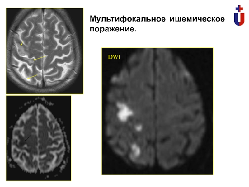 Многоочаговое поражение мозга. Мультифокальная лейкоэнцефалопатия мрт. Прогрессирующая мультифокальная лейкоэнцефалопатия (ПМЛ). Прогрессирующая лейкоэнцефалопатия головного мозга на мрт. Мультифокальное поражение головного мозга мрт.