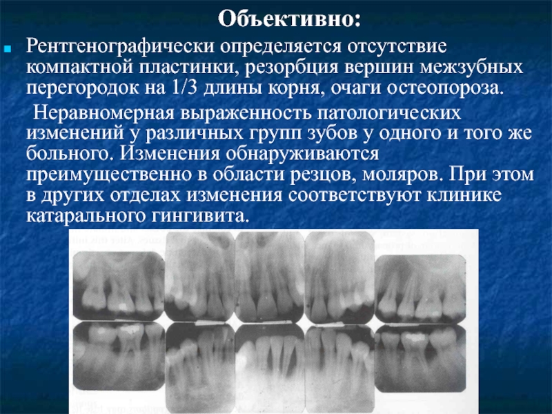 Пародонтит рентгенологическая картина