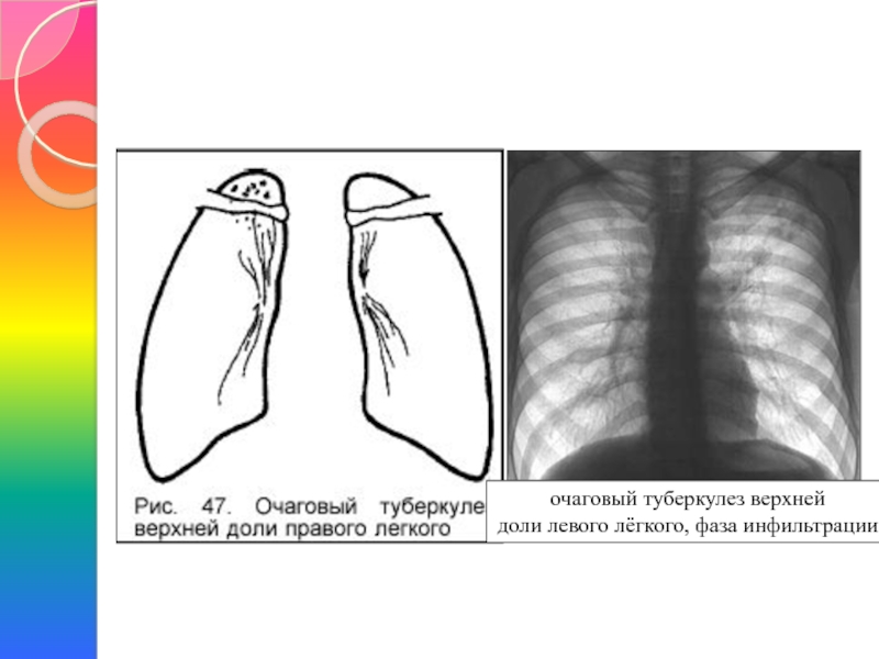 Фазы очагового туберкулеза