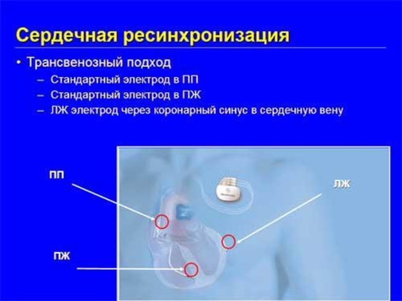 Ресинхронизирующая терапия презентация