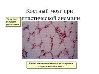 Костный мозг при апластической анемиии