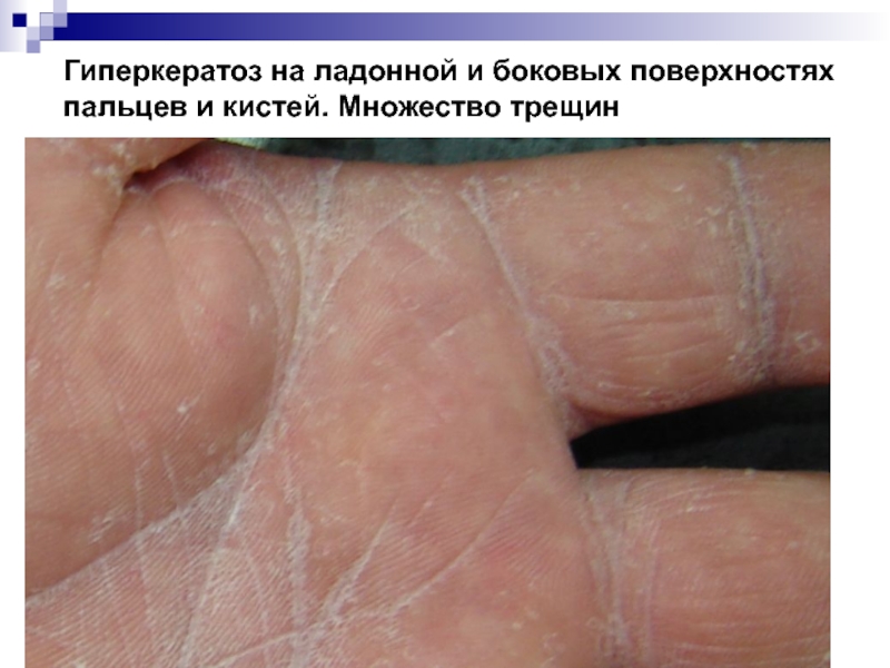Гиперкератоз на ладонной и боковых поверхностях пальцев и кистей. Множество трещин