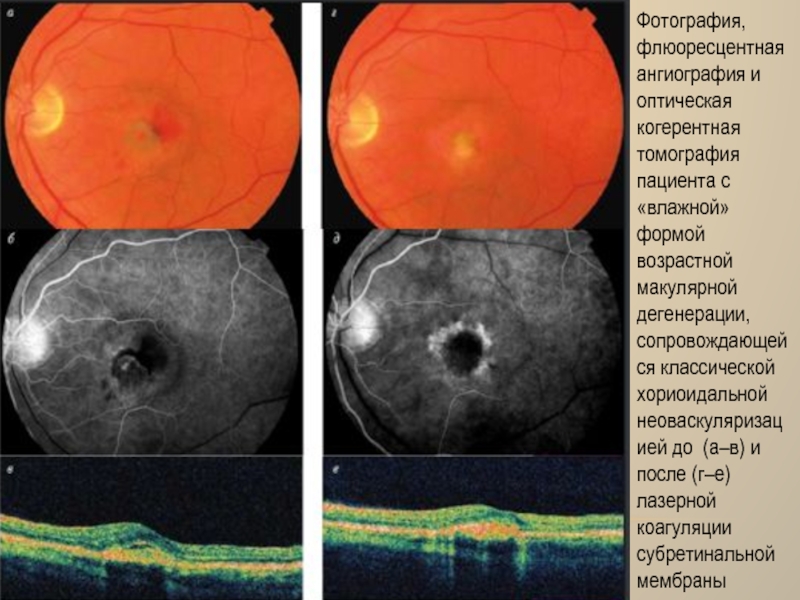 Возрастная макулярная дегенерация презентация