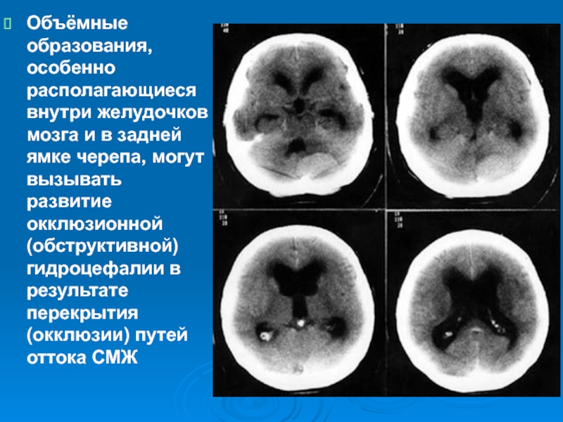 Гидроцефалия головного мозга презентация