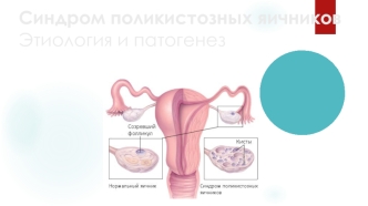 Синдром поликистозных яичников. Этиология и патогенез