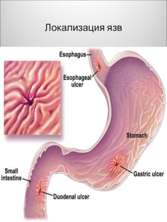 Локализация язв