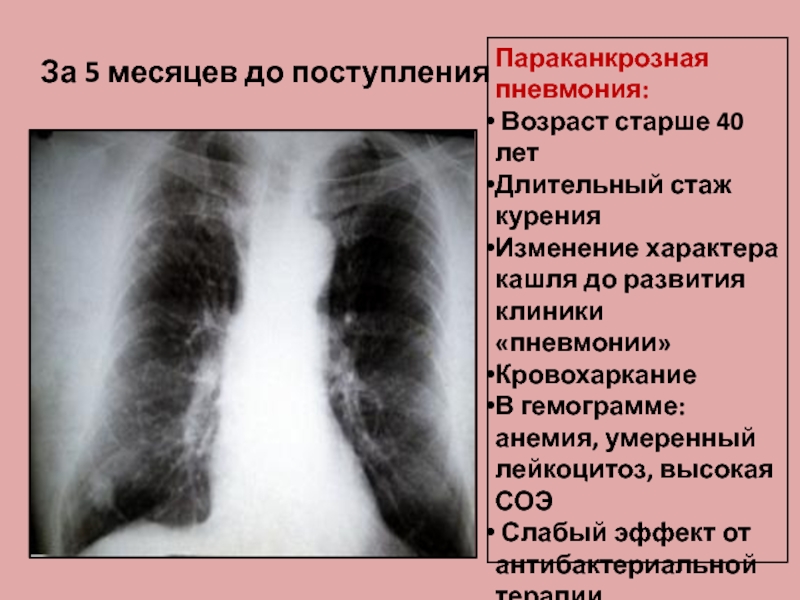 Инфаркт пневмония презентация