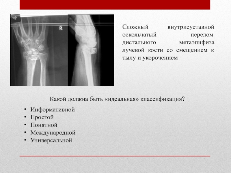 Карта вызова смп перелом лучевой кости закрытый