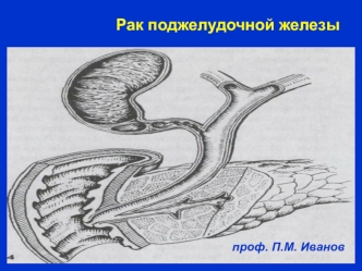 Рак поджелудочной железы