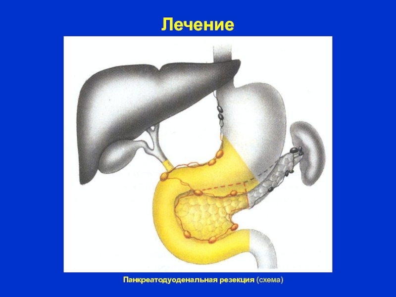 Панкреатодуоденальная резекция схема операции