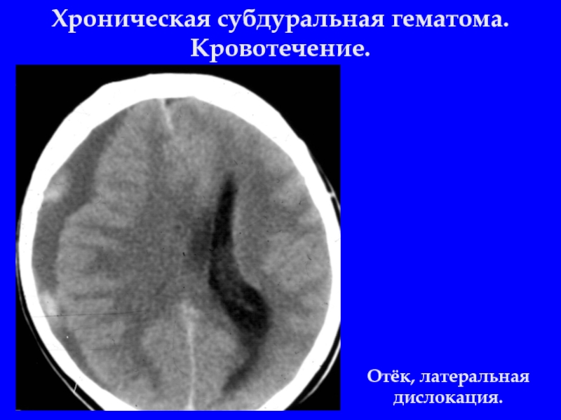 Субдуральная гематома. Подострая субдуральная гематома кт. Хроническая субдуральная гематома на кт. Хронические субдуральные гематомы на кт. Хроническая субдуральная гематома стадии кт.