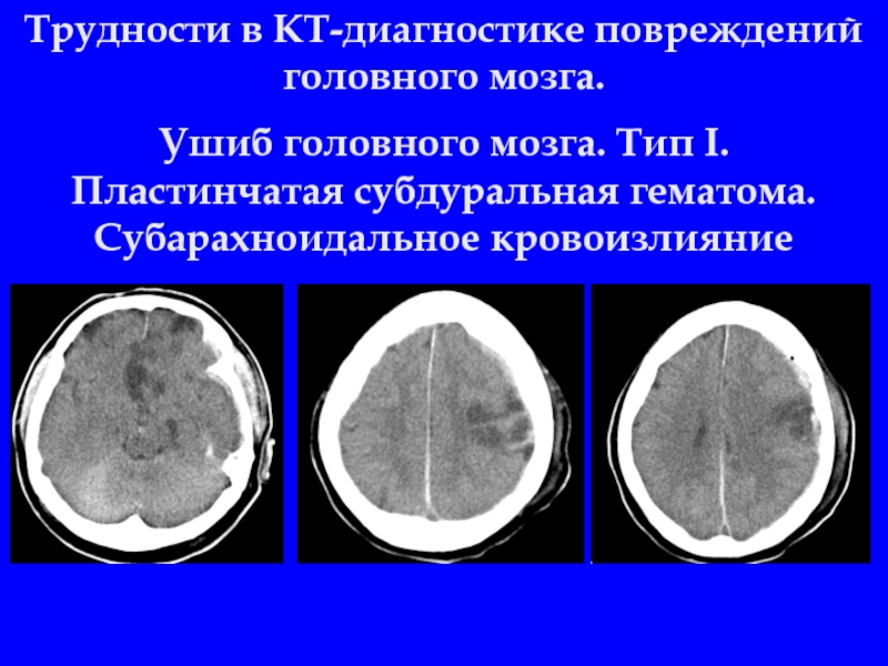 Гематома мозга. Пластинчатая субдуральная гематома кт. Субарахноидальное кровоизлияние кт. Субдуральная гематома головного мозга кт. Пластинчатая субдуральная гематома головного мозга.