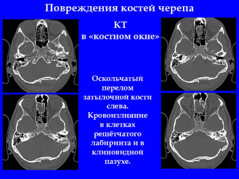 Кт анатомия черепа. ЧМТ повреждения костей черепа. Перелом костей черепа компьютерная томография. Кт костей черепа протокол. Перелом клиновидной кости черепа на кт.