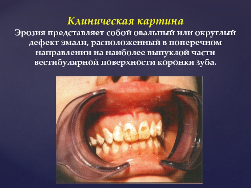 Клиническая картина некариозных поражений