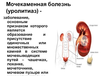 Мочекаменная болезнь (уролитиаз)