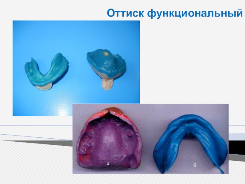 Протез беззубой челюсти. Анатомический оттиск с беззубой верхней челюсти. Оттиск стоматологический. Анатомические и функциональные оттиски. Слепки беззубых челюстей.