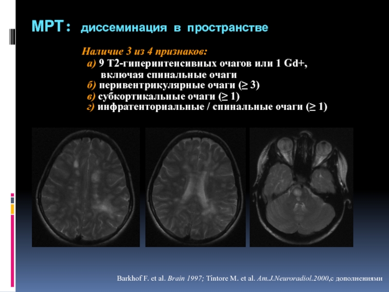 Единичные гиперинтенсивные очаги в субкортикальном