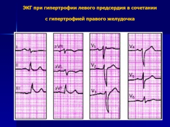 ЭКГ при гипертрофии