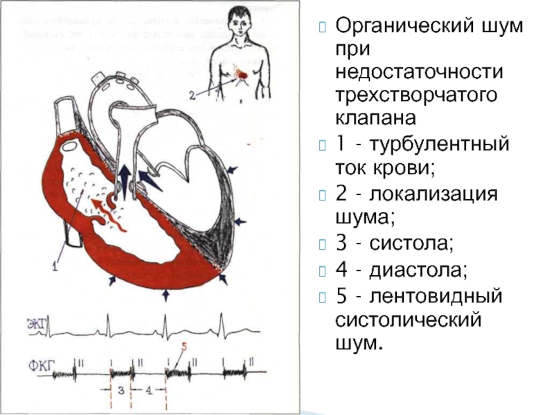 Недостаточность трехстворчатого клапана рисунок