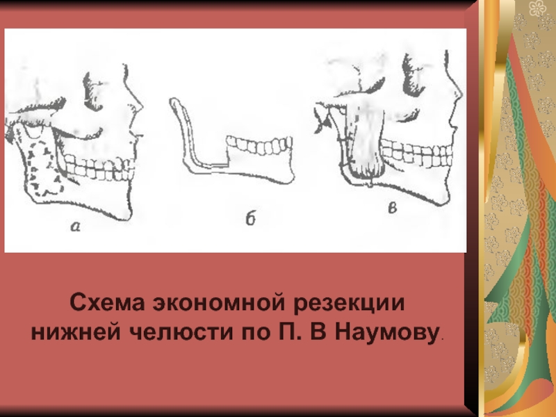 Резекция верхней челюсти презентация