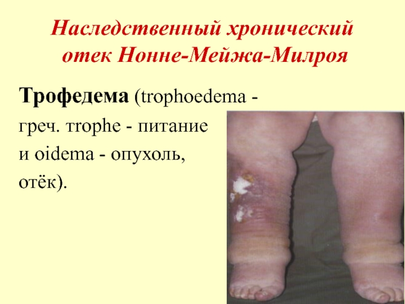 Наследственный хронический  отек Нонне-Мейжа-Милроя Трофедема (trophoedema - греч. тrophe - питание