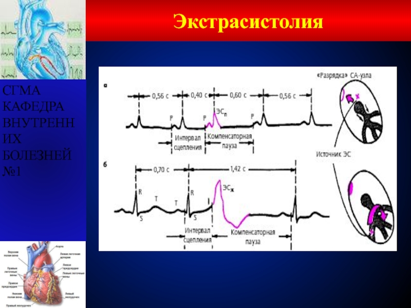 Дефицит пульса