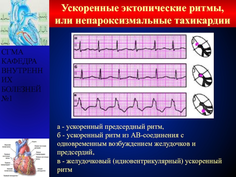 Ритм из ав соединения