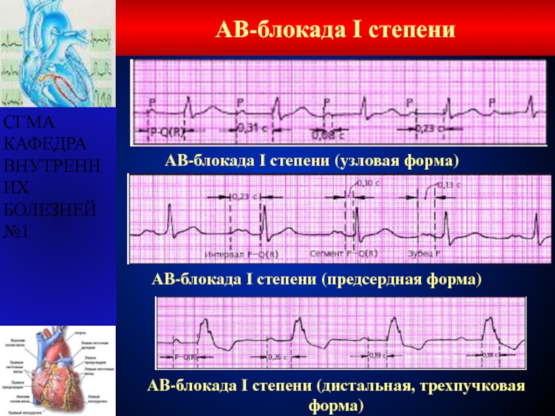 Ав блокада сердца 1 степени