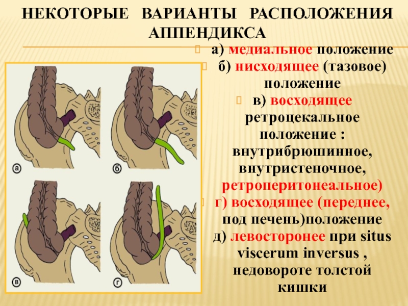 Острый аппендицит презентация