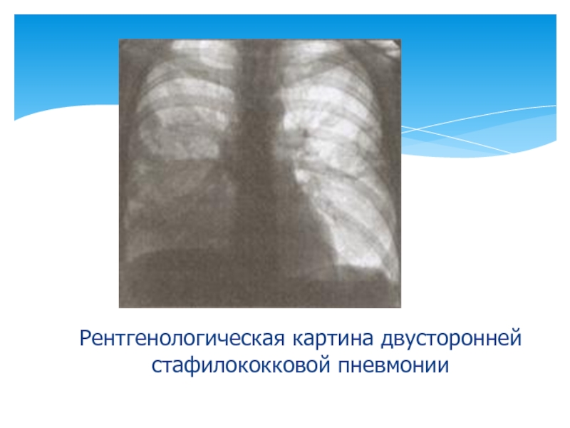 Рентгенологическая картина пневмонии