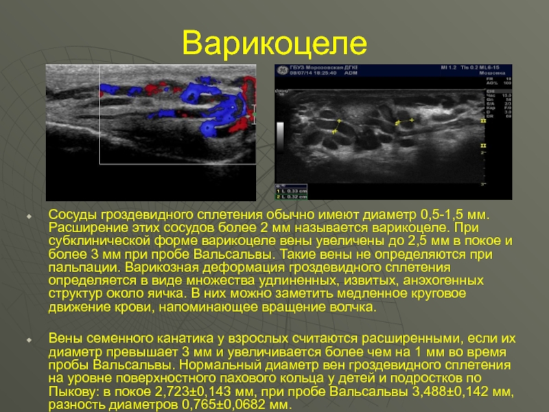 Варикоцеле 2 3