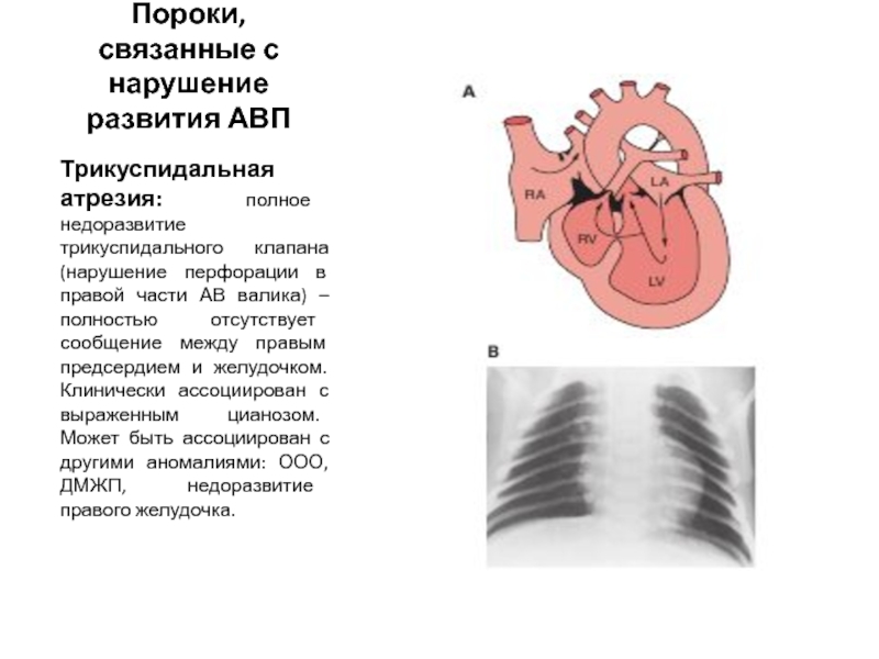 Аускультативная картина пороки сердца