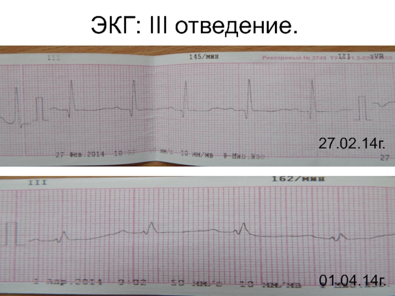 Экг 3. 3 Отведение на ЭКГ. ЭКГ сложные случаи. ЭКГ 3.2.