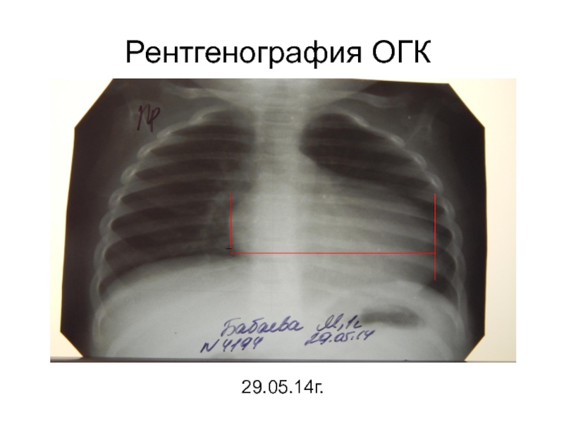 Рентгенография органов грудной клетки. Рентген ОГК. Рентген ОГК расшифровка. Рентген ОГК норма. Рентген ОГК У детей.