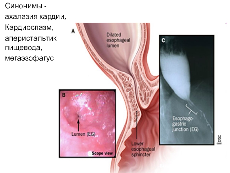 Ахалазии кардии презентация