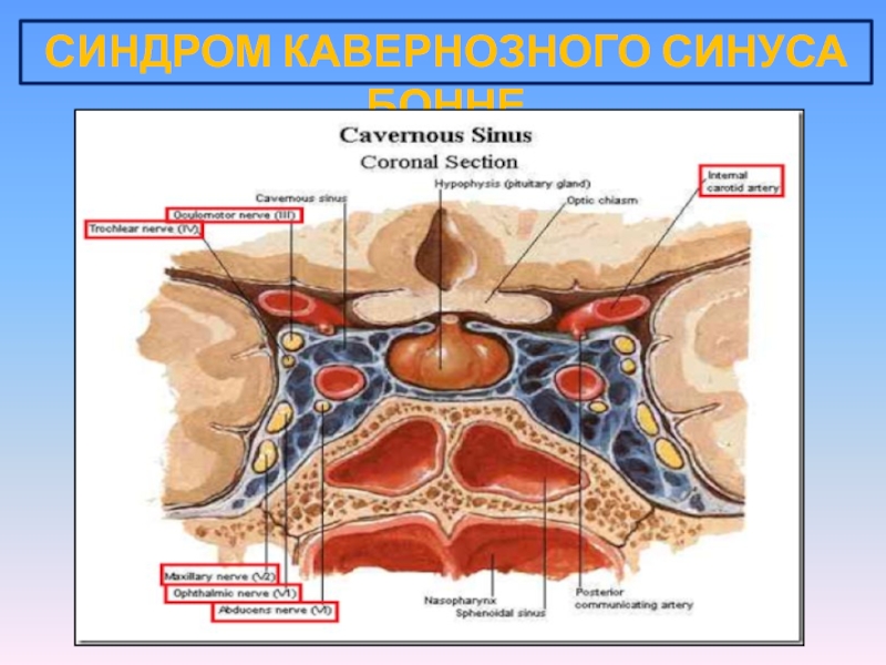 Тромбоз кавернозного синуса фото