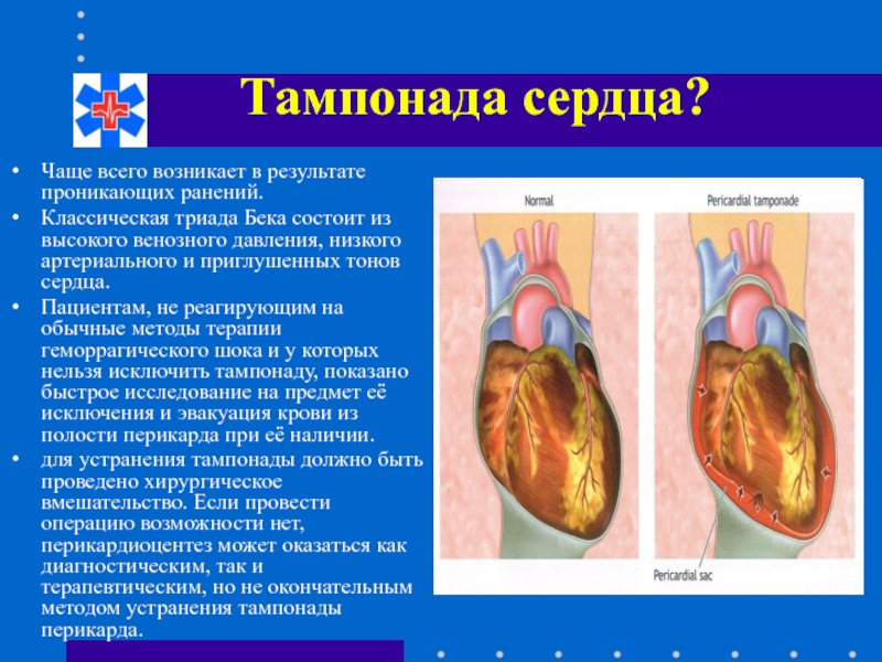 Тампонада сердца презентация