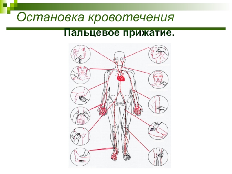 Покажите на рисунке из учебного пособия точки прижатия важнейших артерий сонной