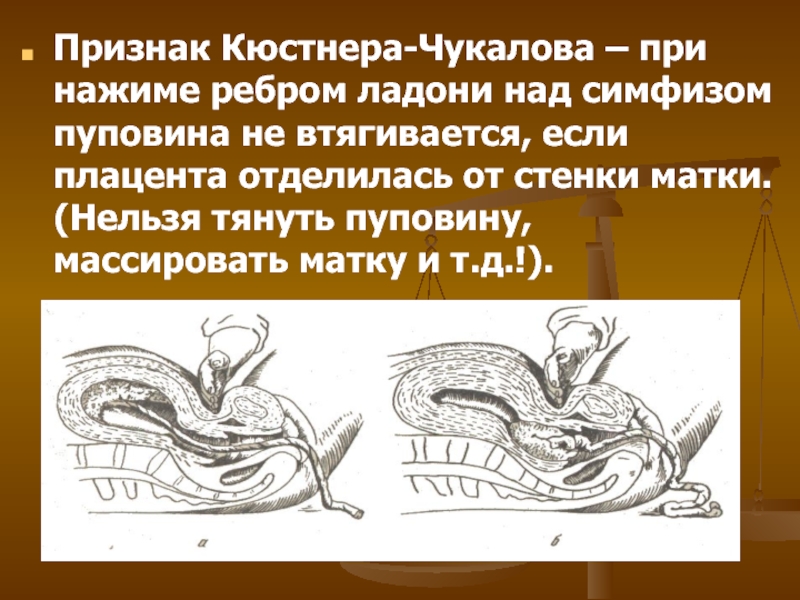 Признаки отделения плаценты. Признак отделения последа Кюстнера-Чукалова. Признак Шредера Альфельда и Кюстнера-Чукалова. Признак Кюстнера Чукалова. Признак отделения плаценты Альфельда.