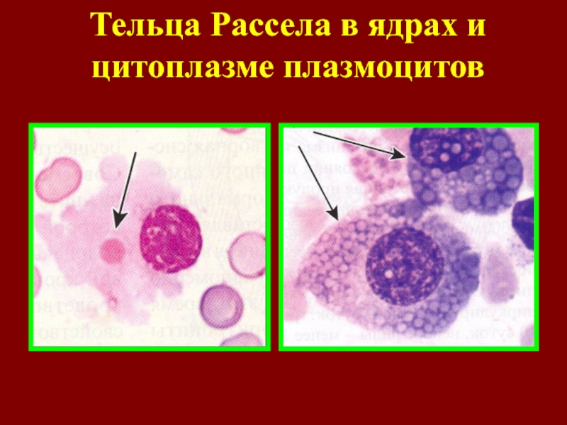 Плазмоциты. Плазмобласт. Превращение в плазмоциты. Плазмоцит ядро. Плазмоциты форма ядра.