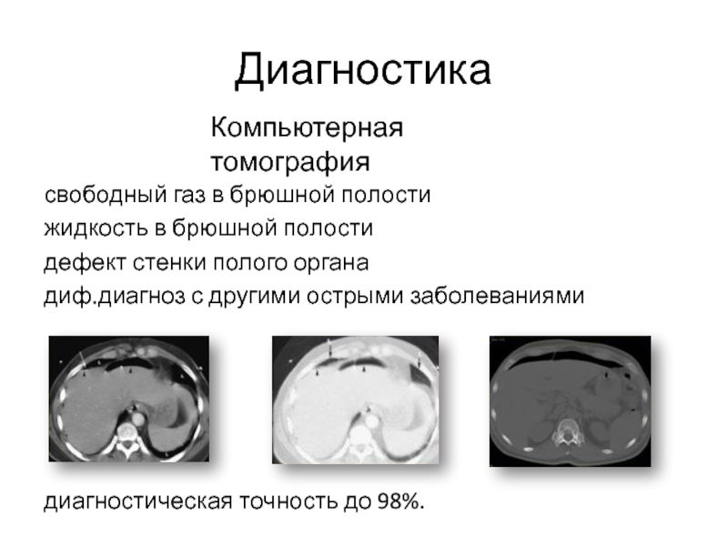 Свободная жидкость в брюшной. Жидкость в брюшной полости на кт. Свободный ГАЗ В брюшной полости на кт. Свободная жидкость в брюшной полости на кт. Воздух в брюшной полости на кт.