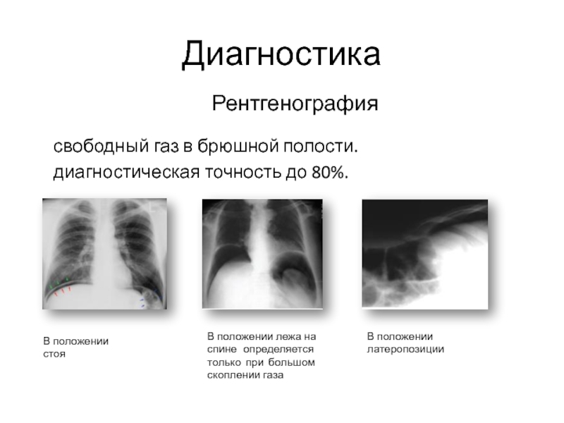 Прободение полого органа рентген схема