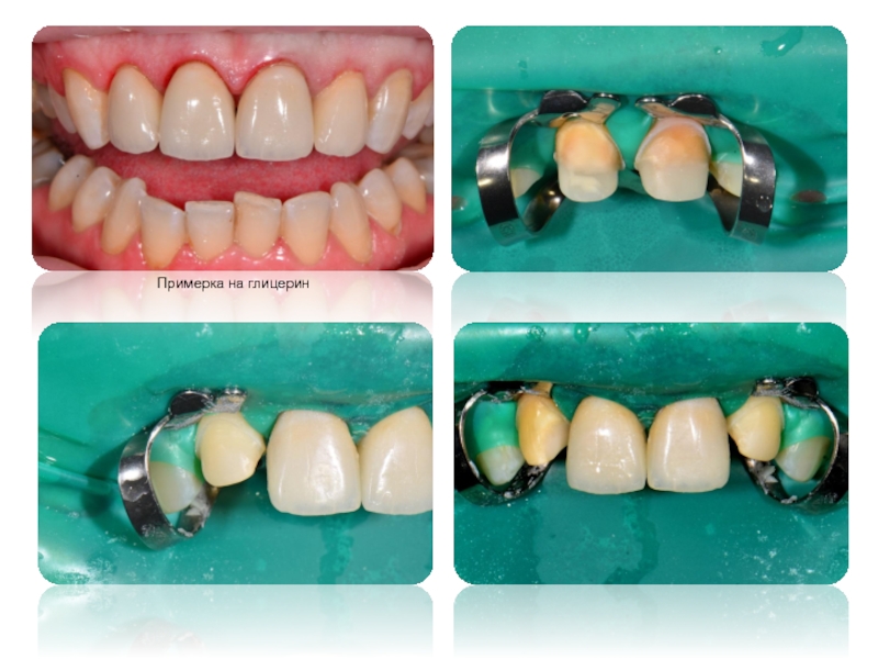Зубное протезирование презентация, доклад