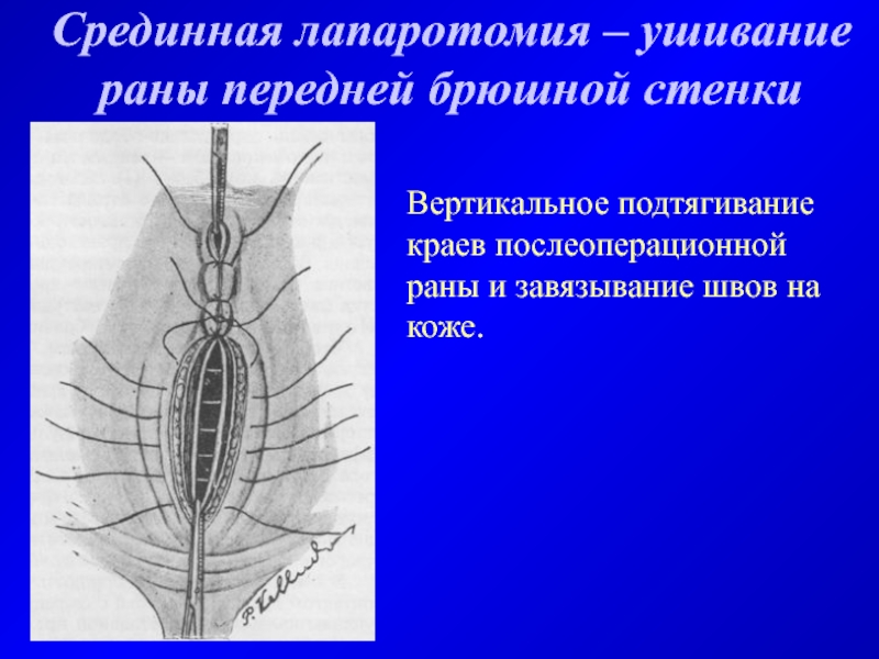 Лапаротомия показания