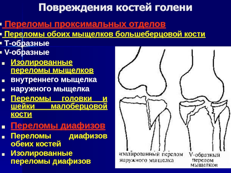 Внутренний мыщелок большеберцовой. Переломы мыщелков большеберцовой кости классификация. Перелом проксимального метафиза большеберцовой кости. Перелом проксимального отдела большеберцовой кости. Вколоченный перелом малоберцовой кости.