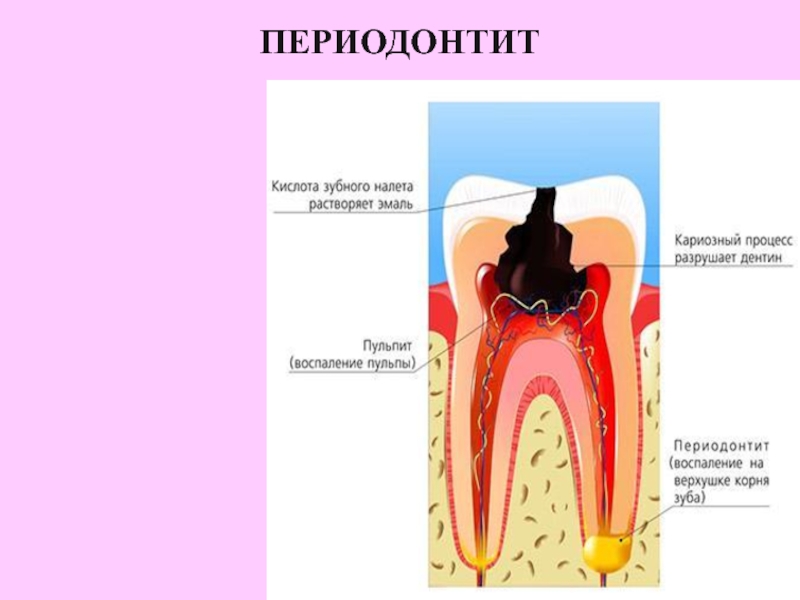 Хронические формы пульпита презентация