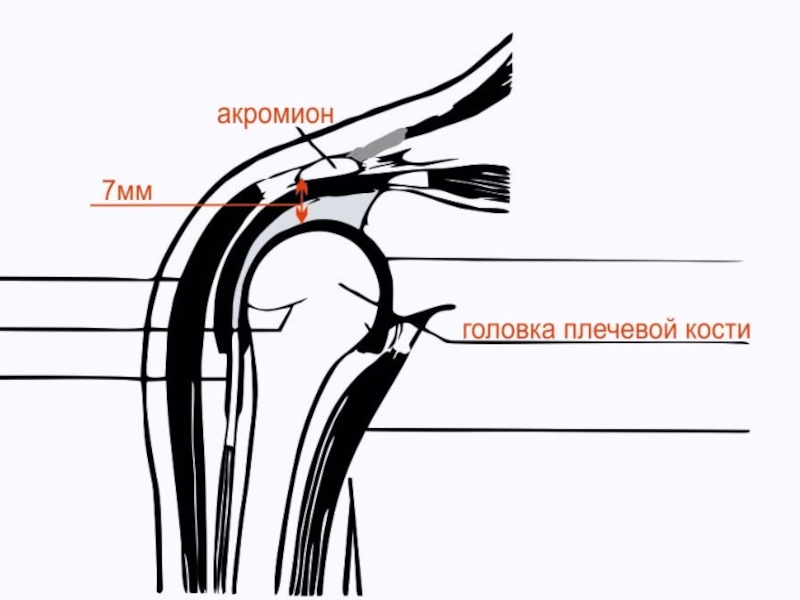 Импичмент плечевого сустава. Импиджмент плечевого сустава мрт. Импиджмент синдром плечевого сустава мрт. Субакромиальное пространство плечевого сустава норма. Субакромиальное пространство плечевого сустава норма мрт.