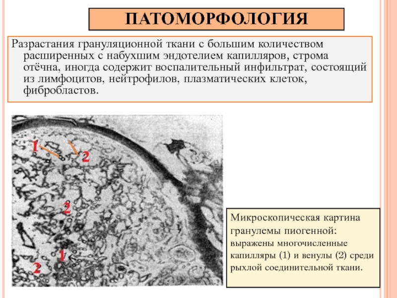 Грануляционная ткань